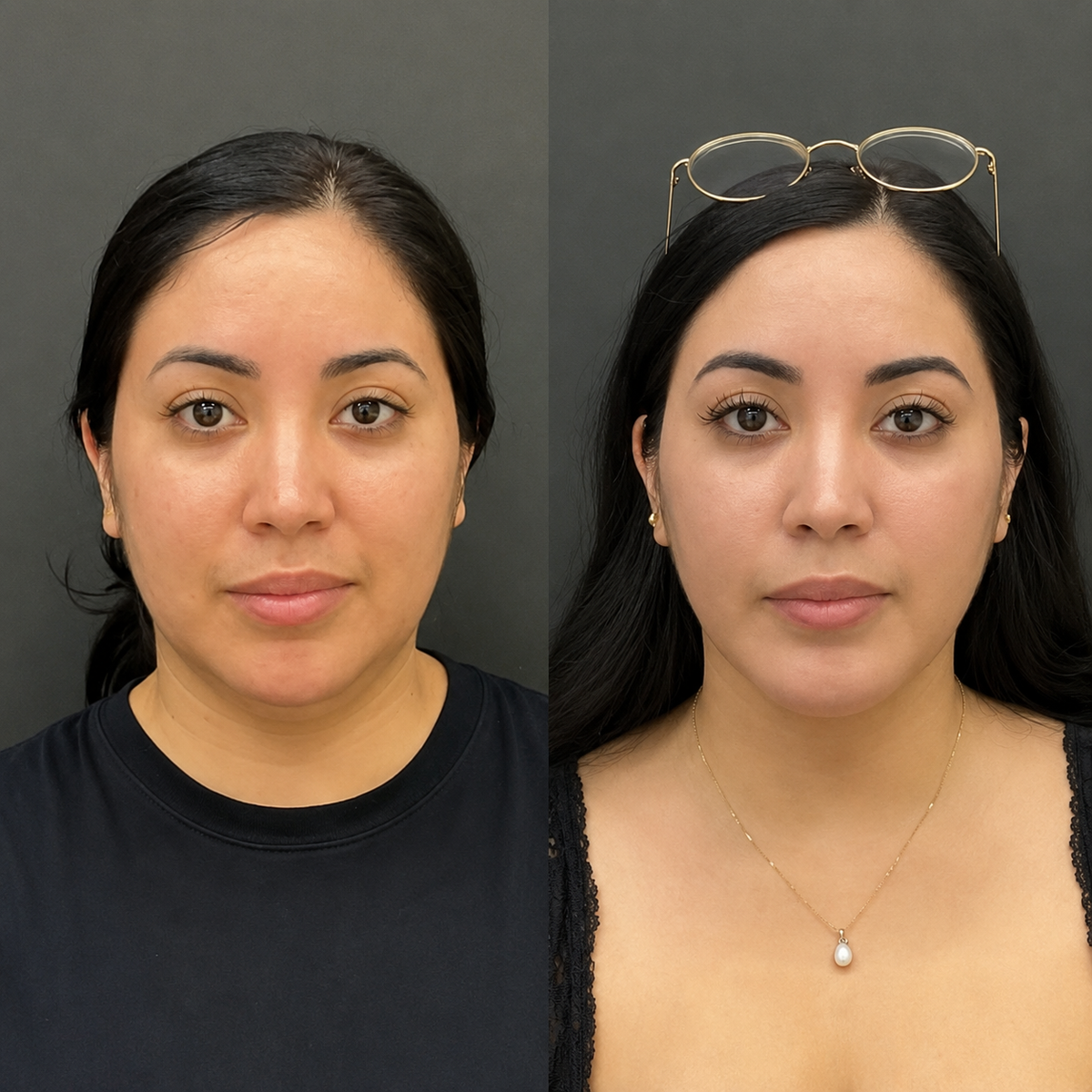 Before and after for Aisha